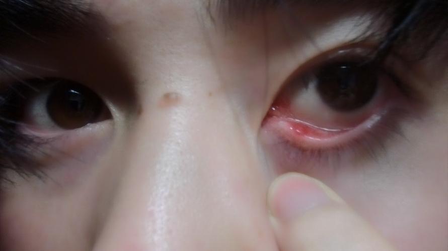 下眼皮眼角内测红肿且有脓包,是什么问题啊?