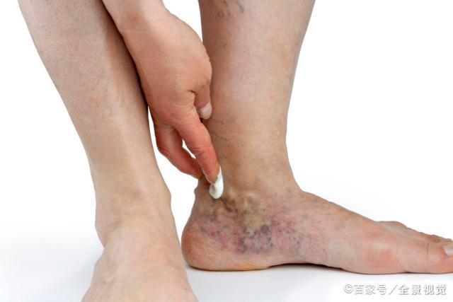 下肢静脉曲张的临床表现为下肢肿胀,湿疹,色素沉着等