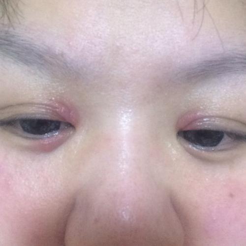 眼角红肿特别痒 最要命的是上眼皮眼角的部位还裂口