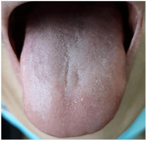 胃癌舌苔图片什么颜色