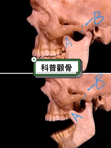额弓内推的极限】一科普贴 1下颌骨喙突a到额弓之间的距离2从正面看