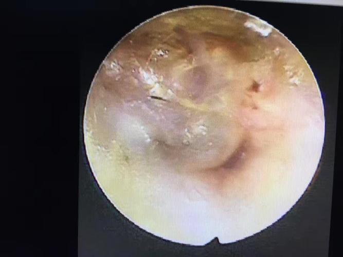 耳鼓膜穿孔术前与术后二十天对比照片