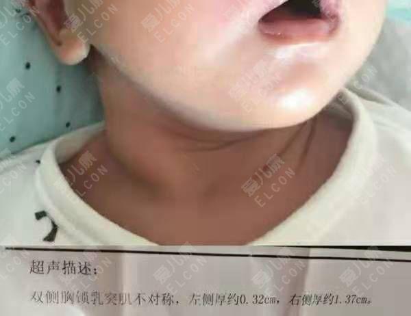 宝宝脖子上有个疙瘩是怎么回事最佳治疗期按摩就能消失