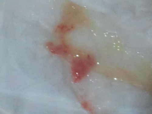 鼻涕中有血,10天前发现的,一开始是血丝,后来发现用纸巾进去纸上有血
