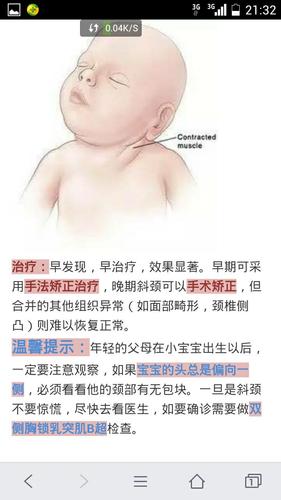 宝宝先天性肌性斜颈