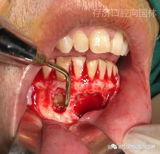 牙根尖切除手术多少钱