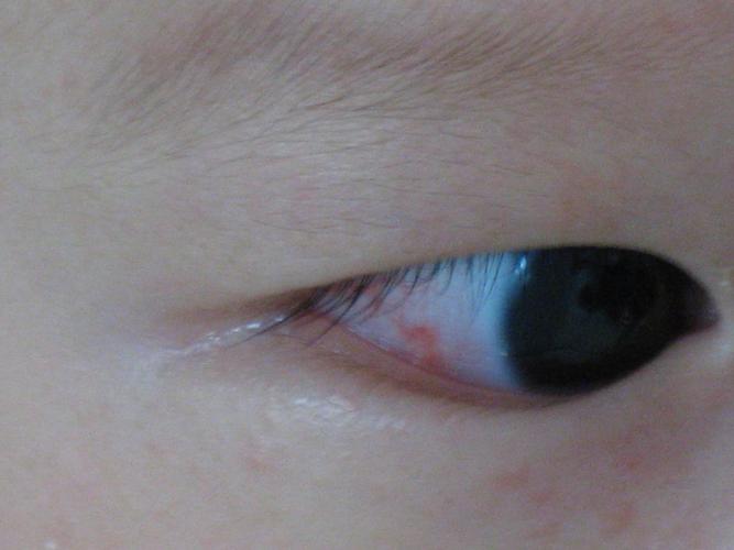 4个月的小孩,右眼的右半边眼白布满血丝, 但是右眼的左半边和整个左眼