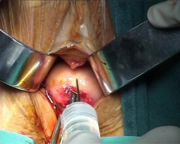 【手术视频】冷刀宫颈锥形切除术