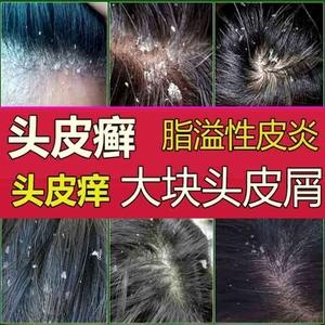 头皮癣药膏真菌感染头皮屑湿疹专用牛皮癣断根头部洗发水特效治疗
