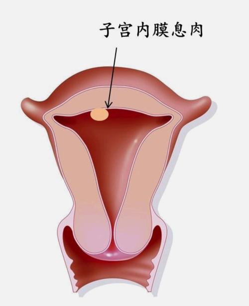 同样是子宫内膜息肉,为什么处理却不同?