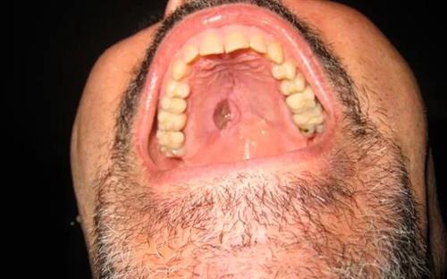 口腔癌早期图片