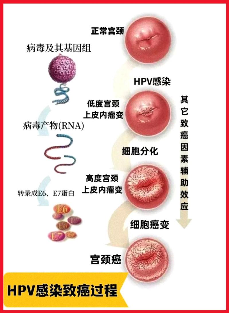 1,hpv全名叫人乳头瘤病毒,会导致人得宫颈癌通常是通过性接触传播的一
