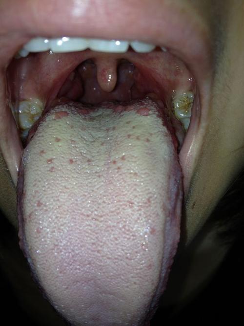 舌头根部和舌头两侧长东西,舌头根部有好多个跟黄豆一样大小的肉粒.