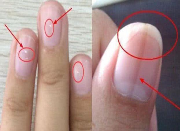 手指甲竖纹代表身体什么信号