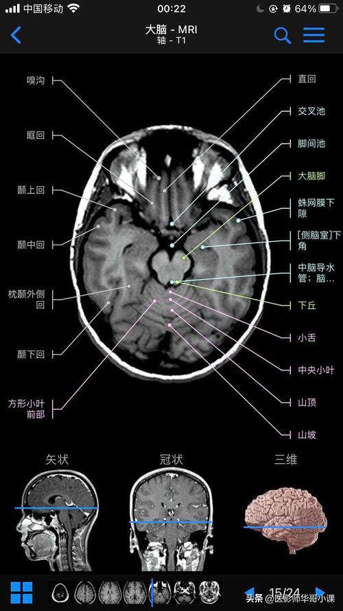 「高清mri图」头颅断层磁共振解剖