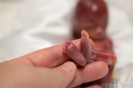 孕期22周出生了世界上存活最小的婴儿看的人心疼