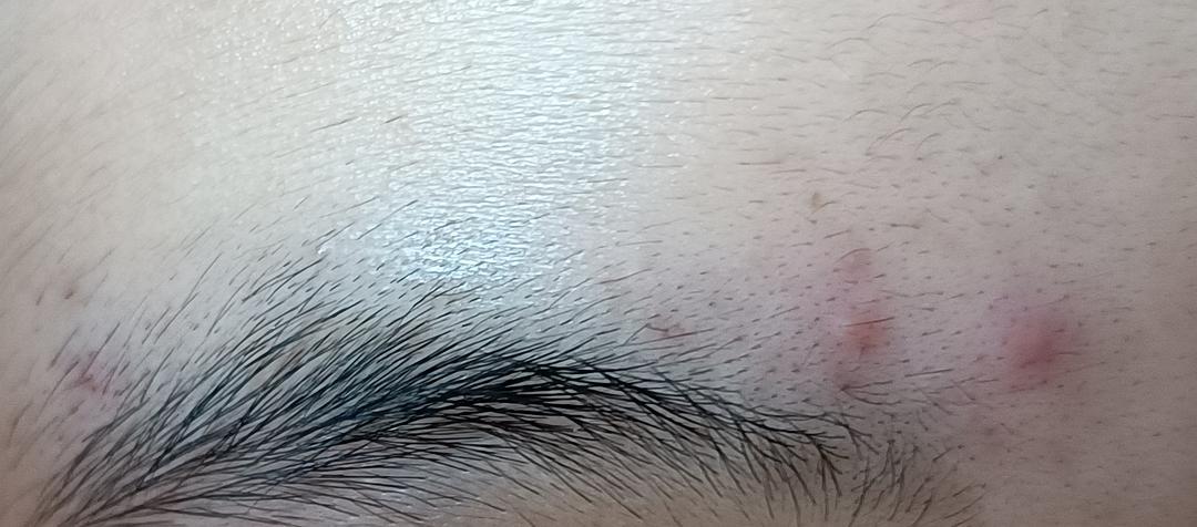 男生眉毛中间长痘痘是什么原因
