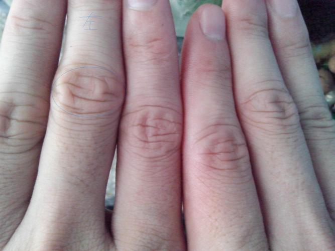 问:左手指关节肿大