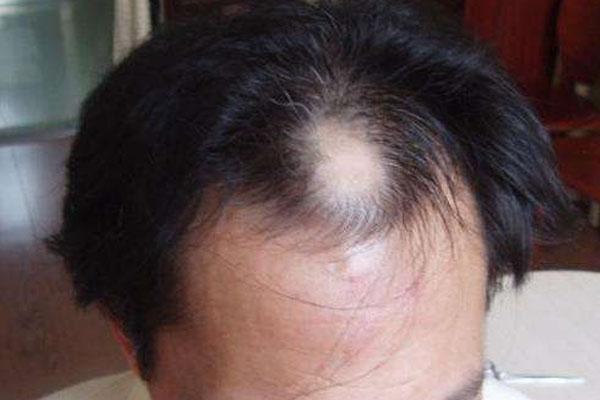男性脱发原因 男性脱发要怎么治疗 男性为何经常脱发