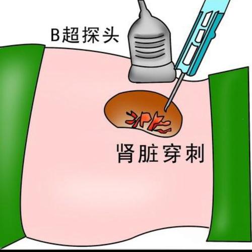广济医院成功开展首例肾穿刺活检术