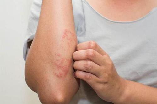 特应性皮炎和湿疹经常出现在婴儿湿疹,不会传染.