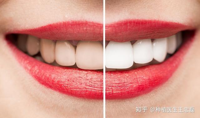 美白牙贴使用低浓度的过氧化氢漂白牙齿.