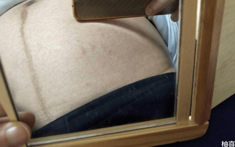 孕妇开始长妊娠纹有前兆图文揭秘常见早期症状