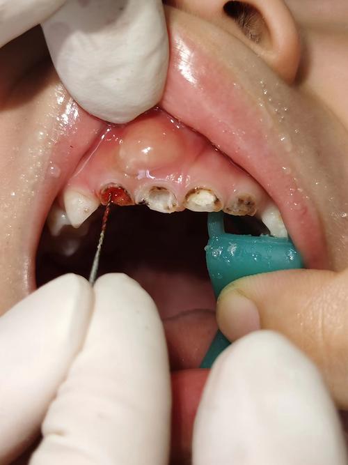 的间隔在1个星期左右,治疗期间需注意不用正在接受治疗的牙齿咬硬食物