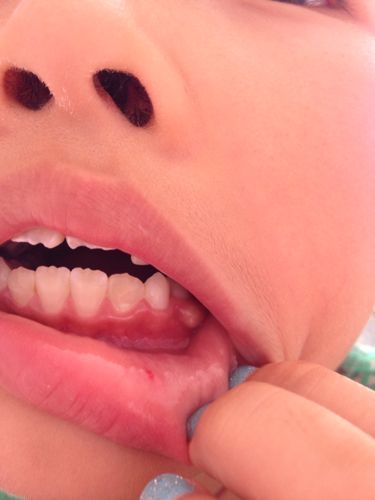 八岁的孩子牙龈处长了这样的东西,无疼痛感.