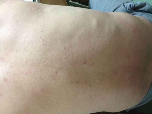 后背和手臂上长了好多红疹,很痒,已经持续一个月.