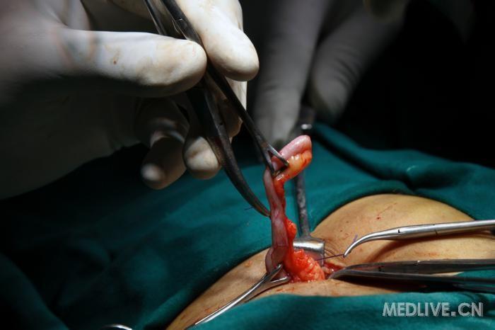 开腹手术 ◆外科医生通过右下腹单一切口切除阑尾 ◆开腹手术是阑尾