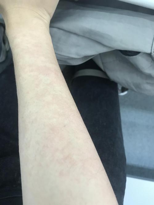 手臂荨麻疹