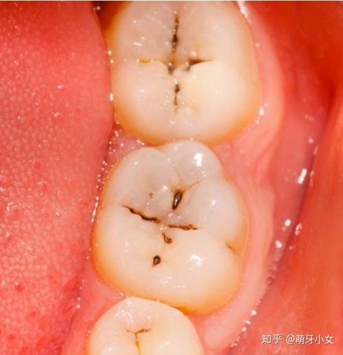 早期的后牙有蛀牙是没有明显的龋洞,大多在咬合面有黑色的勾线,很多