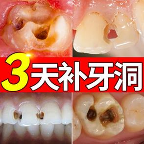 补牙齿洞膏补牙缝修复蛀牙烂牙自己在家补牙填牙洞填充剂清理神器