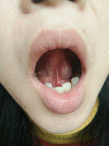 舌头下面起了长条透明泡,不痛,无意中发现的,请问有什么问题