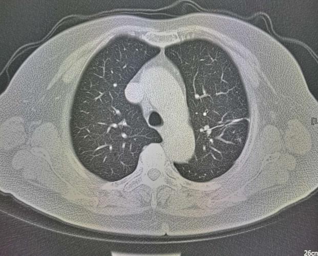 左肺错构瘤1例