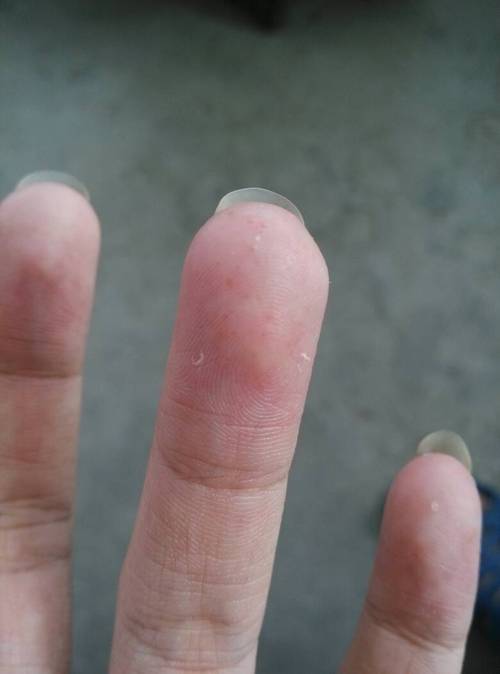 2013-08-16 李翠英 医师 手指头二层皮有水泡,几天之后就涨起来,皮破