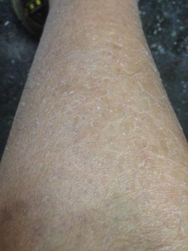 小腿皮肤干燥,缺水!表皮自然脱落的现象,小腿表面就像是干旱的土地!