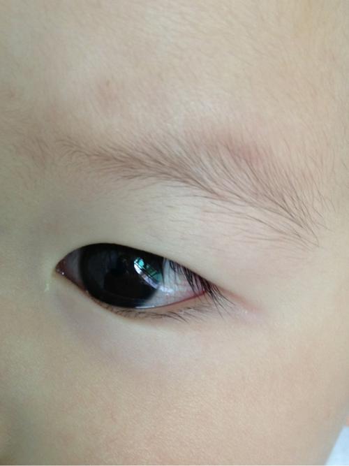 宝宝眼睛很多红血丝怎么回事啊