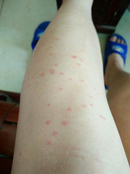 来湛江的第一天身上就有痘痘了一开始有一点点而且不痒一天后就越来越
