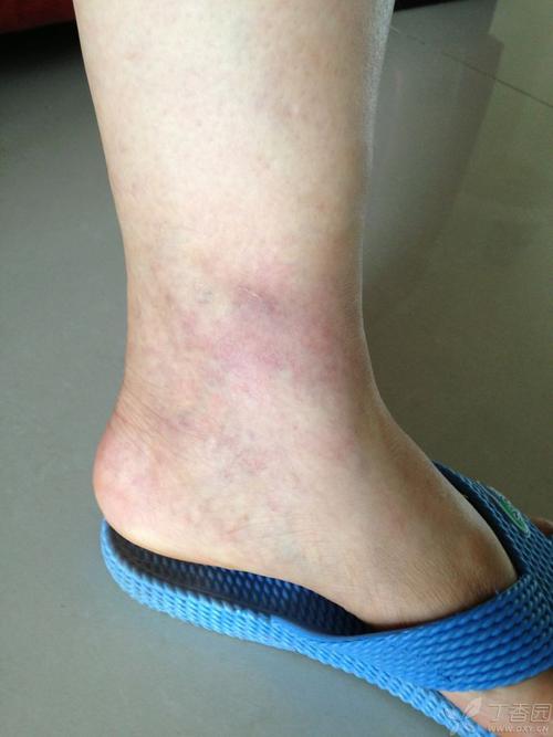 【求助】内侧脚踝周围有大片青紫斑,压痛,站立或行走时间长会痛,是