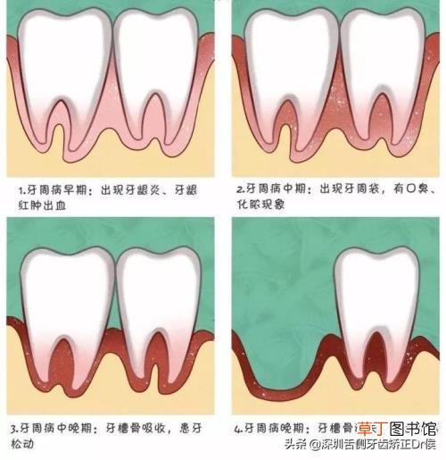 牙龈经常出血是什么原因引起的_为什么你的牙龈总是出血