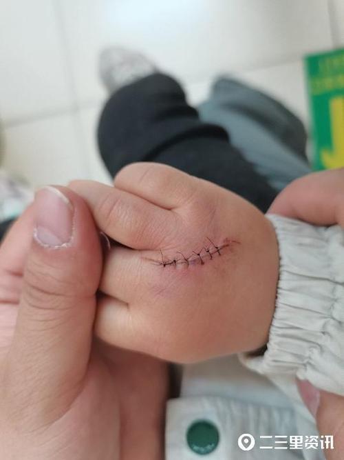 1岁多幼童在酒店旋转门玩耍被夹伤手掌缝了9针,金豪酒店:监护人未尽