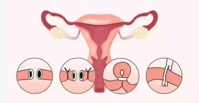 输卵管吻合术为结扎女性重开孕育通道