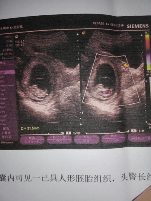 怀孕时间短,医生也无法通过b超判断胎儿