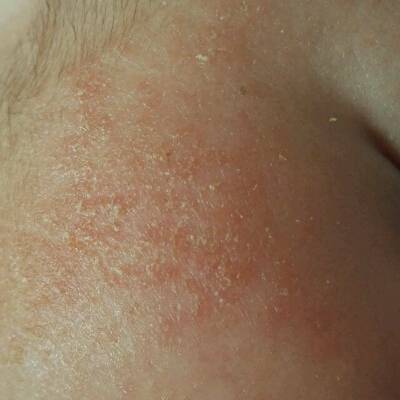 宝宝两个月脸上有湿疹,用金银花水洗了一次就开始起皮,这是更严重了