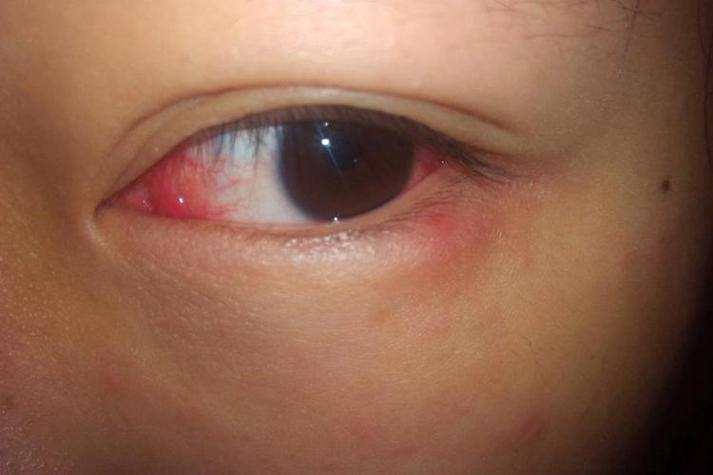 眼白红血丝的最佳改善方法有哪些(眼白红血丝的最佳改善方法有哪些