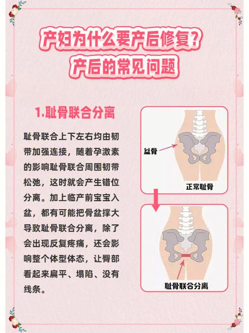 耻骨联合分离耻骨联合上下左右均由韧带加强连接,随着孕激素的影响