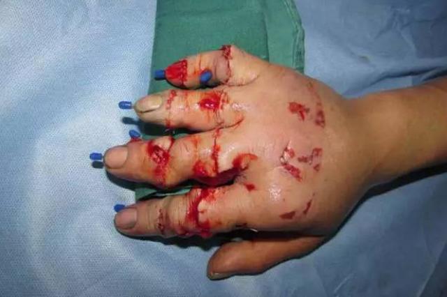 工人手指被机器压伤 女骑警开道16分钟送医