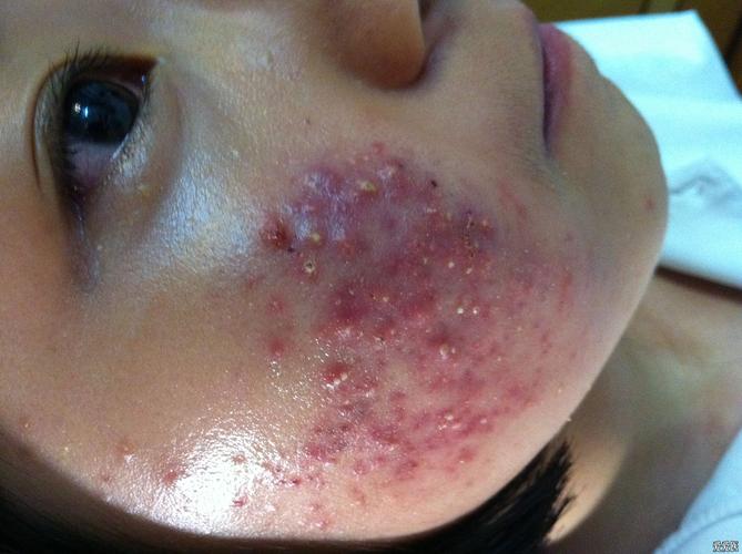 面部痤疮合并马拉色菌感染皮损